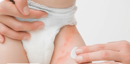 how to remove diaper rash" - Learn about diaper rash symptoms, causes, and remedies