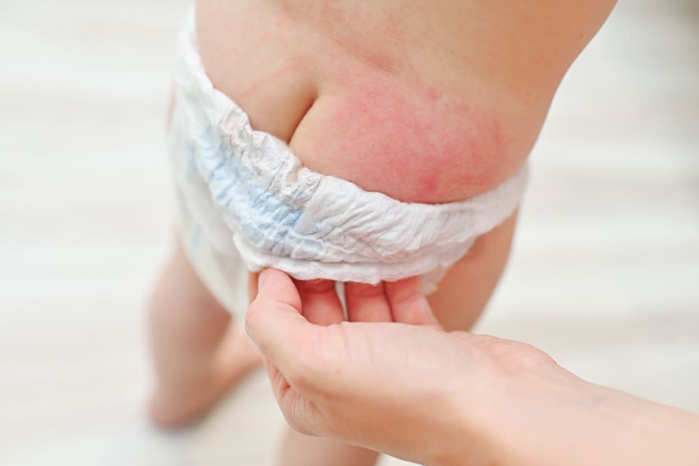 What are the Causes of a Diaper Rash?