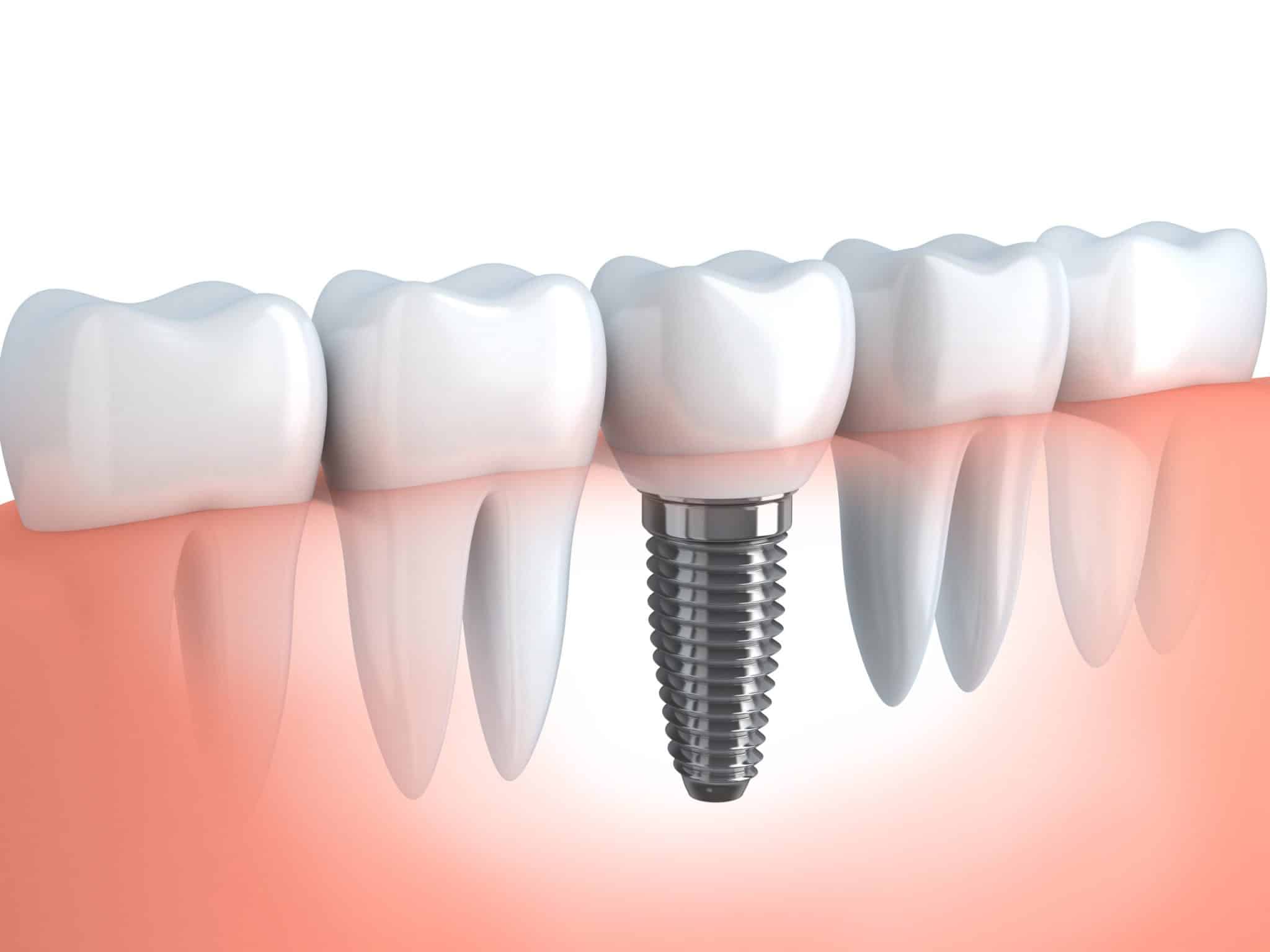 Dental Implants: A Permanent Solution