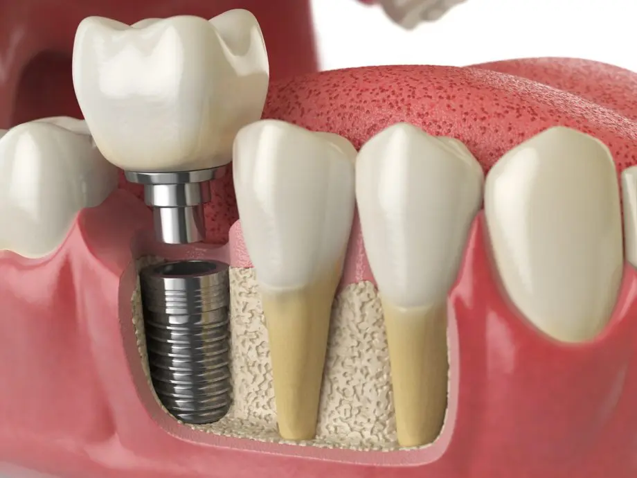 The Process of Getting Dental Implants