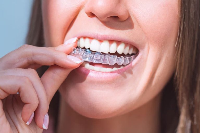 5 Reasons Why Invisible Braces Are Trending in Orthodontic Treatment
