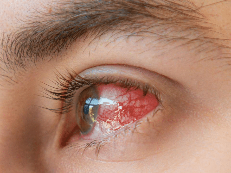 Eye Problems from Not Enough UV Protection